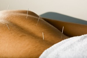 Acupuncture for back pain